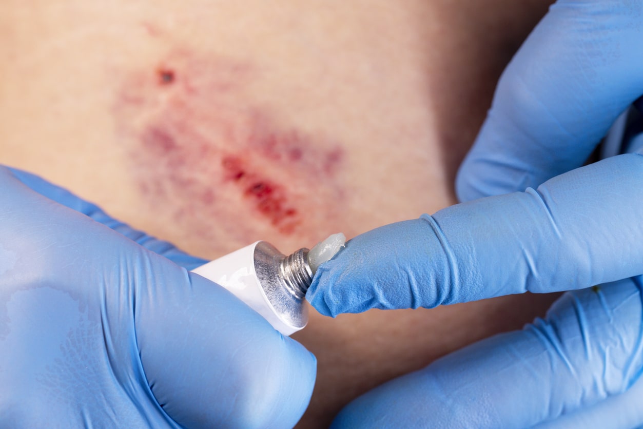 What Are the Signs of an Infected Dog Bite?