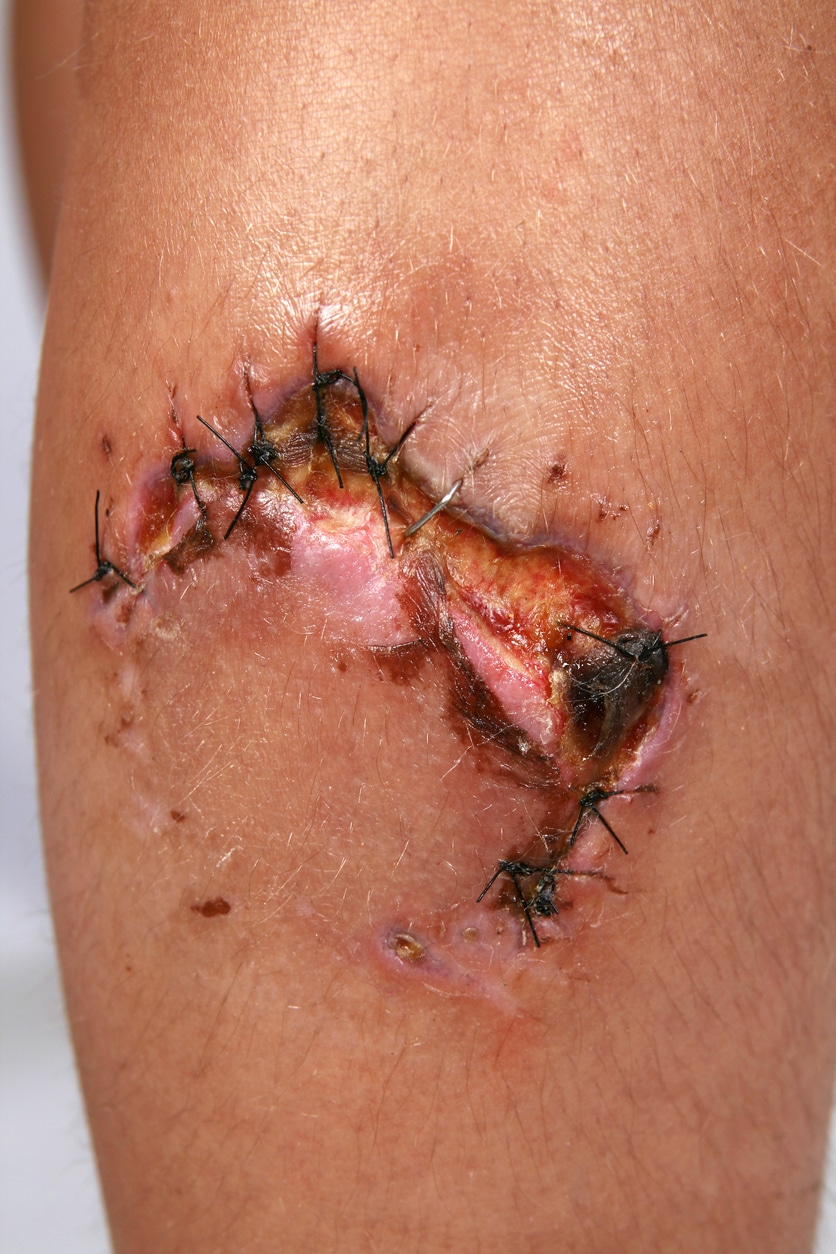 Most Common Dog Bite Injuries