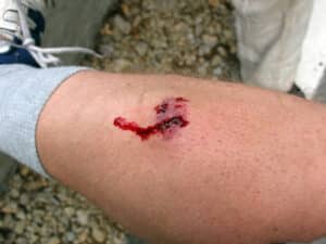 common dog bite injuries - lacerations