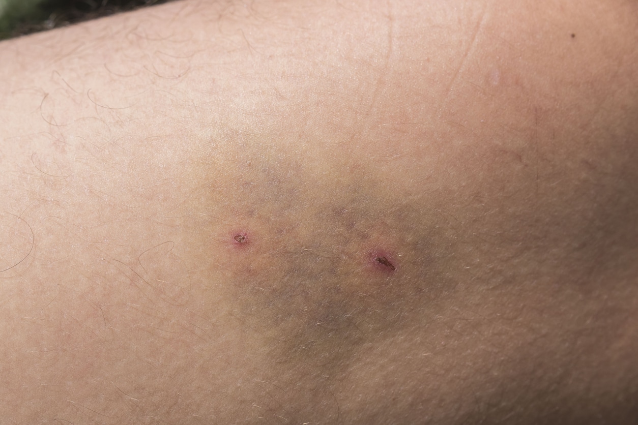 Dangerous Symptoms After a Dog Bite