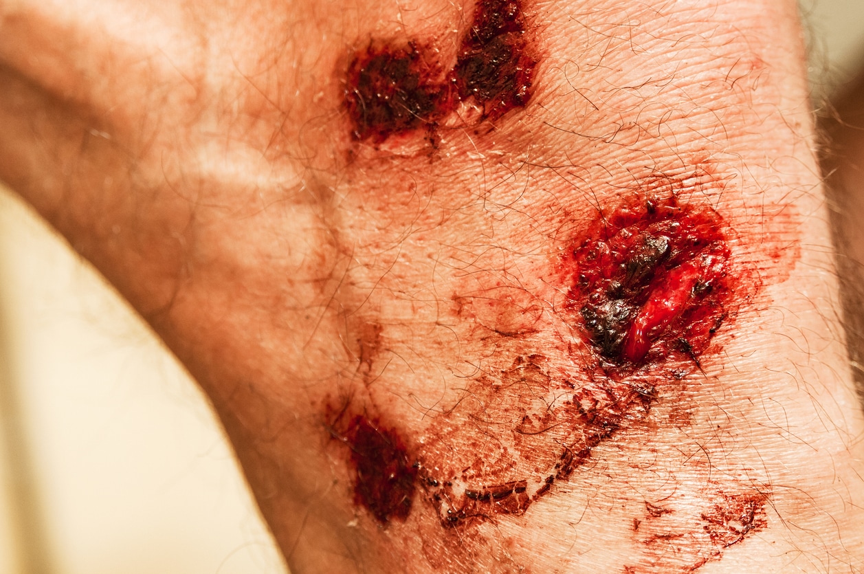 How to Prevent Infections After a Dog Bite