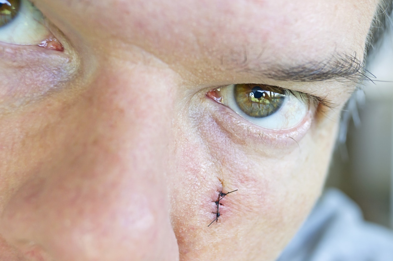 How to Minimize Scarring After a Dog Bite