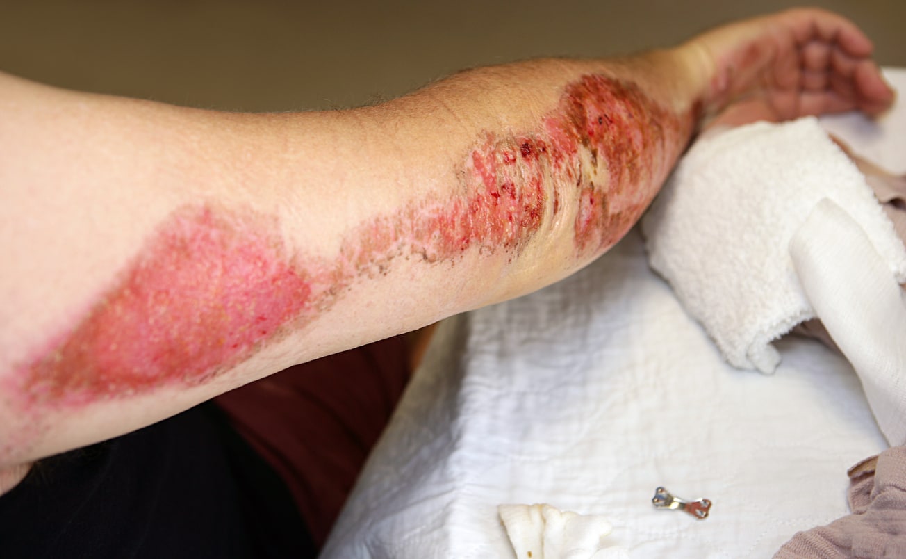 Road Rash After a Motorcycle Accident: What You Need to Know